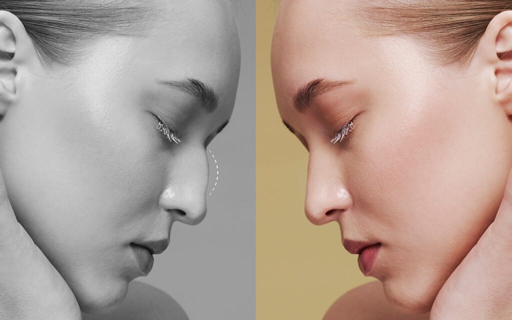 Bien préparer sa rhinoplastie en Tunisie