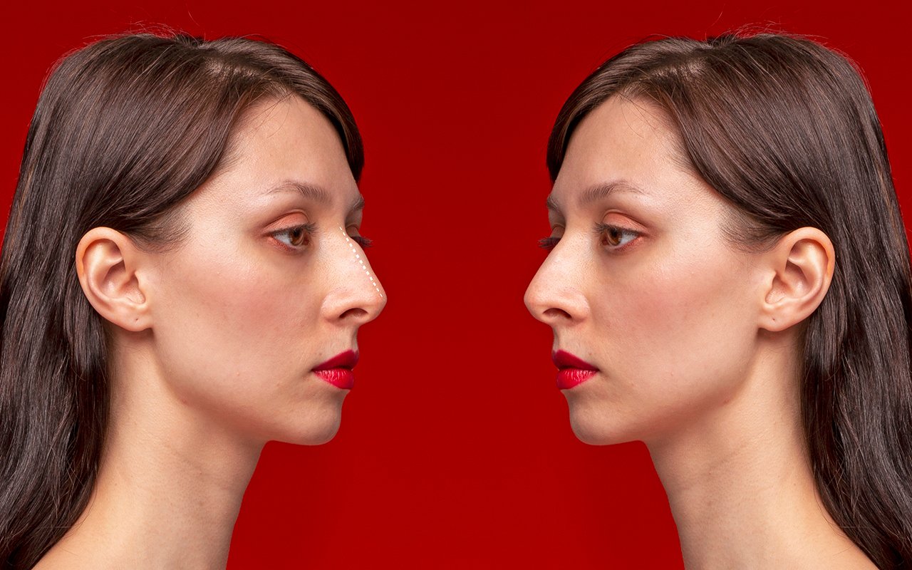 Rhinoplastie de la pointe du nez