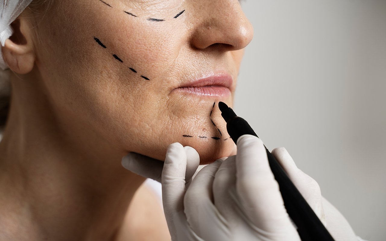 Techniques chirurgicales pour corriger le double menton